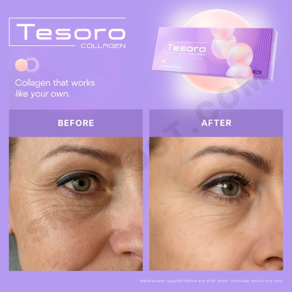 TESORO Collagen Skin Booster - Image 4