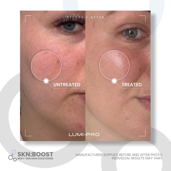 lumi-pro skin booster before and after