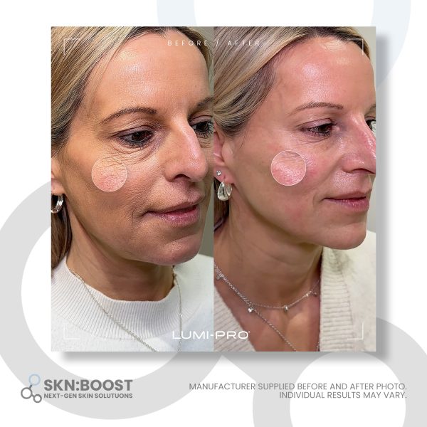 LUMI-PRO before and after